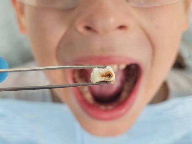 Best Emergency Treatment for Dental Infections or Abscesses in Rochester Hills, MI