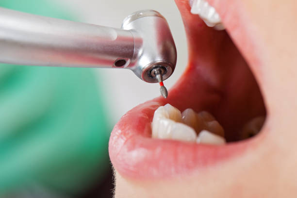 Best Emergency Treatment for Dental Infections or Abscesses in Rochester Hills, MI